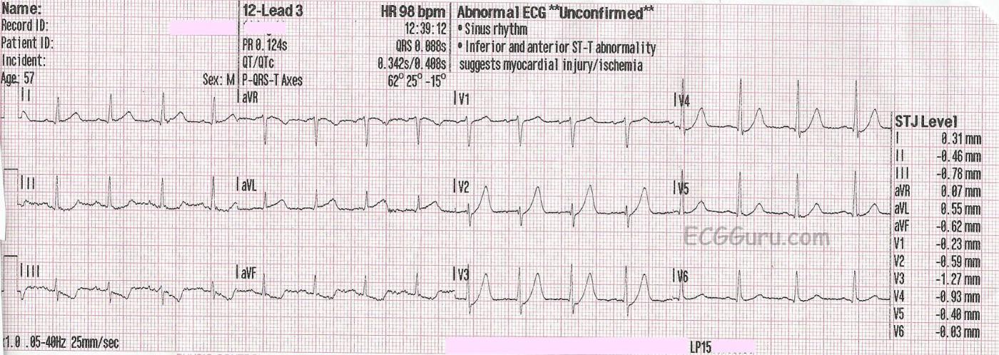 Hyperacute T Waves De Winter T Waves Ecg Guru Instructor Resources 